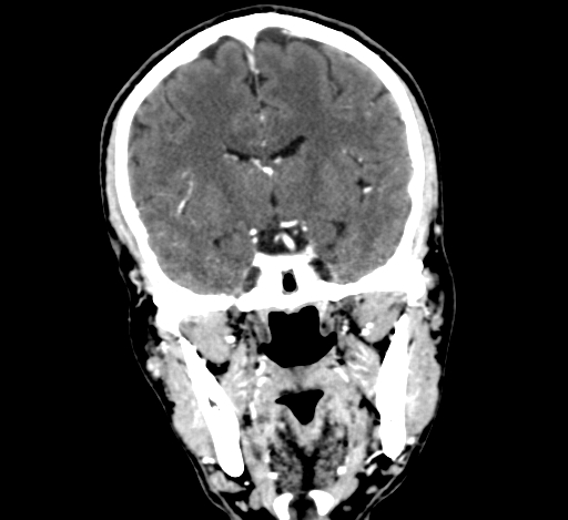 Chronic invasive fungal sinusitis with intraorbital and intracranial extension (Radiopaedia 56387-63046 C 201).jpg