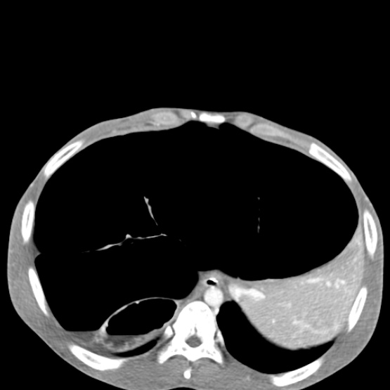File:Chronic large bowel pseudo-obstruction (Radiopaedia 43181-46492 A 42).jpg