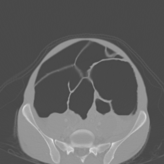 Chronic large bowel pseudo-obstruction (Radiopaedia 43181-46492 Axial bone window 127).jpg
