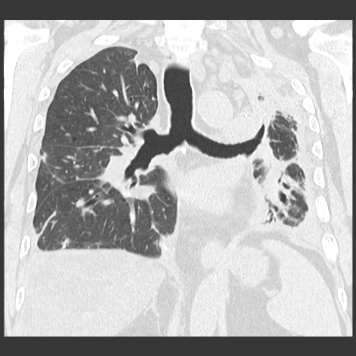 File:Chronic lung allograft dysfunction - restrictive form (Radiopaedia 60595-68316 Coronal lung window 62).jpg