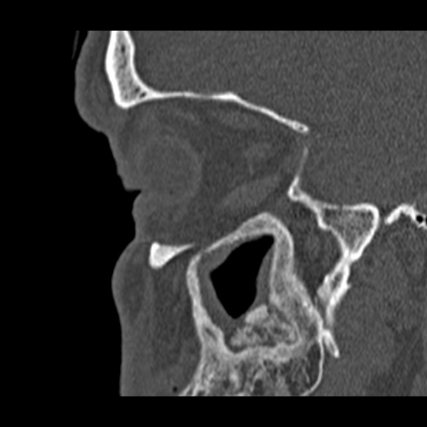 Chronic maxillary sinusitis (Radiopaedia 27879-28116 Sagittal bone window 43).jpg