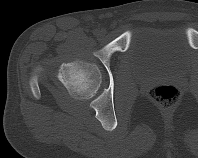 Chronic ostemyelitis of the femur with long sinus tract (Radiopaedia 74947-85982 Axial bone window 2).jpg
