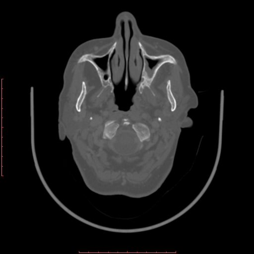 Chronic osteomyelitis - maxilla (Radiopaedia 23783-23927 Axial bone window 98).jpg