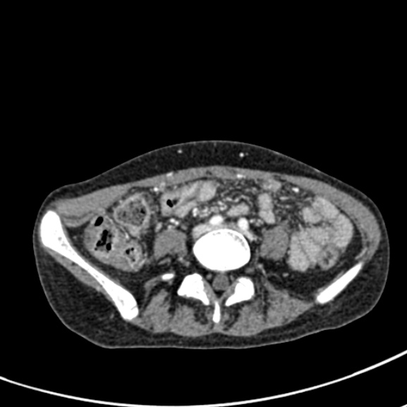 Chronic pancreatitis (Radiopaedia 55405-61846 A 68).jpg