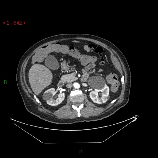 Circumaortic left renal vein and doubled left renal arteries (Radiopaedia 52268-58158 A 78).jpg