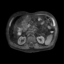 Cirrhosis and hepatocellular carcinoma in the setting of hemochromatosis (Radiopaedia 75394-86594 Axial T1 C+ fat sat 30).jpg