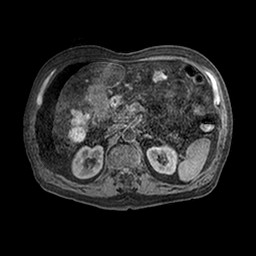 File:Cirrhosis and hepatocellular carcinoma in the setting of hemochromatosis (Radiopaedia 75394-86594 Axial T1 C+ fat sat 31).jpg