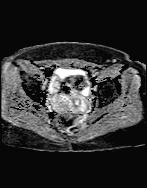 File:Class II Mullerian duct anomaly- unicornuate uterus with rudimentary horn and non-communicating cavity (Radiopaedia 39441-41755 Axial ADC 17).jpg
