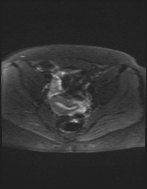 File:Class II Mullerian duct anomaly- unicornuate uterus with rudimentary horn and non-communicating cavity (Radiopaedia 39441-41755 Axial DWI 15).jpg