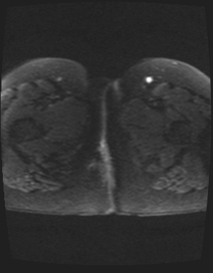 Class II Mullerian duct anomaly- unicornuate uterus with rudimentary horn and non-communicating cavity (Radiopaedia 39441-41755 Axial DWI 32).jpg