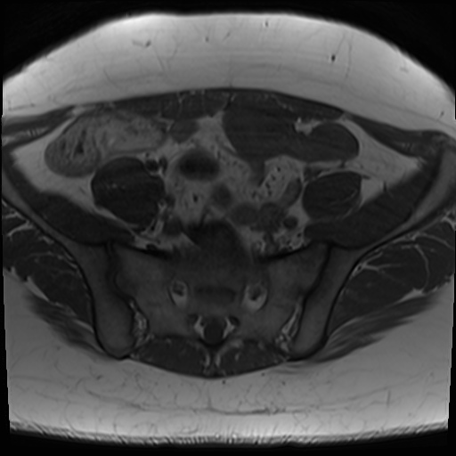 File:Class II Mullerian duct anomaly- unicornuate uterus with rudimentary horn and non-communicating cavity (Radiopaedia 39441-41755 Axial T1 6).jpg