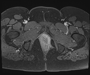 File:Class II Mullerian duct anomaly- unicornuate uterus with rudimentary horn and non-communicating cavity (Radiopaedia 39441-41755 Axial T1 fat sat 136).jpg
