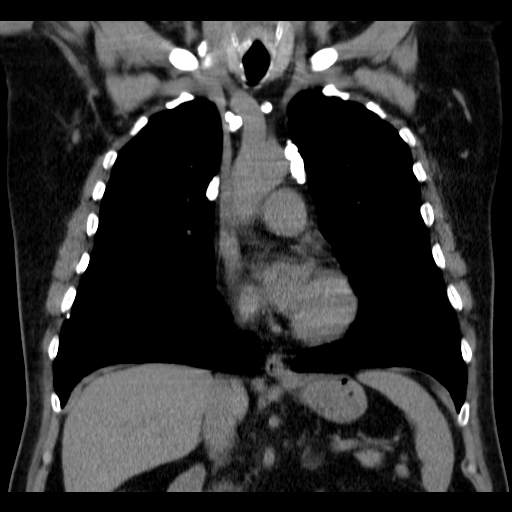 File:Classic complicated silicosis (Radiopaedia 49720-54961 Coronal liver window 26).jpg