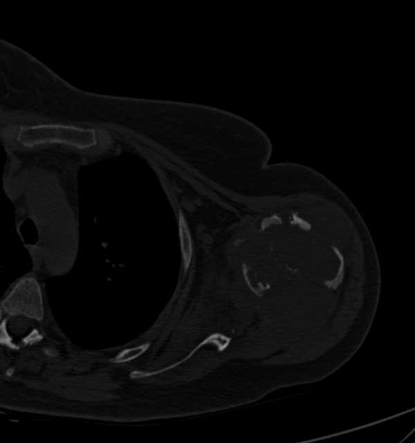 Clear cell chondrosarcoma - humerus (Radiopaedia 63104-71612 Axial bone window 51).jpg