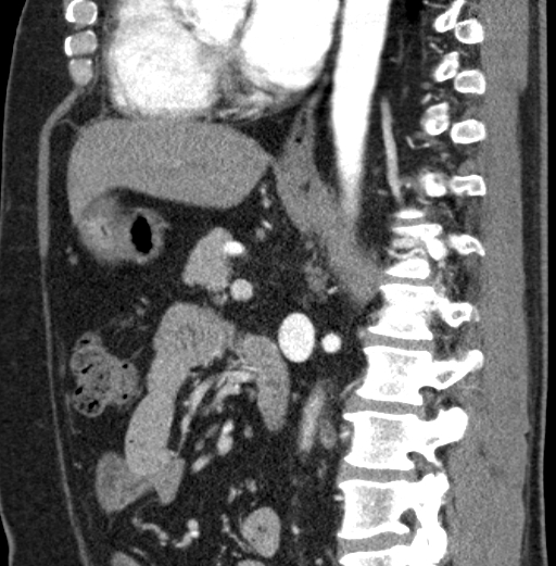 File:Clear cell renal cell carcinoma (Radiopaedia 61449-69393 D 49).jpg