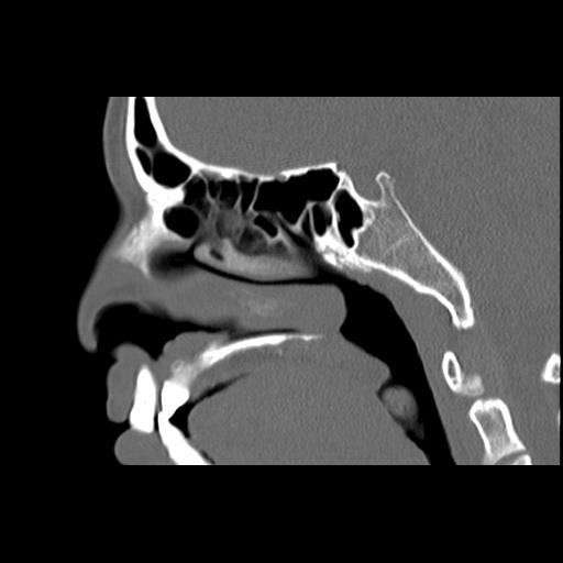 Cleft hard palate and alveolus (Radiopaedia 63180-71710 Sagittal bone window 24).jpg
