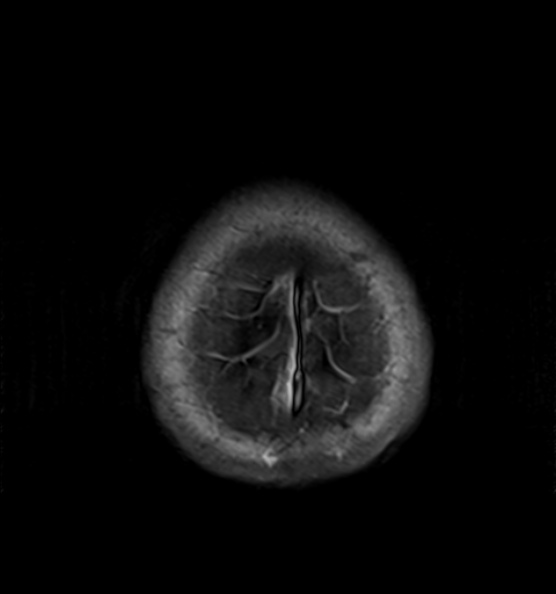 File:Clival meningioma (Radiopaedia 53278-59248 Axial T1 C+ 24).jpg