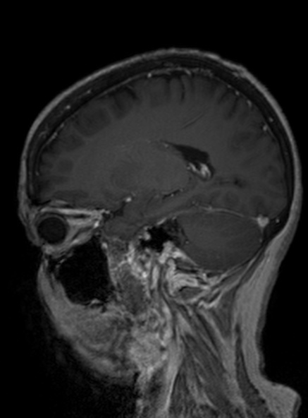 Clival meningioma (Radiopaedia 53278-59248 Sagittal T1 C+ 300).jpg