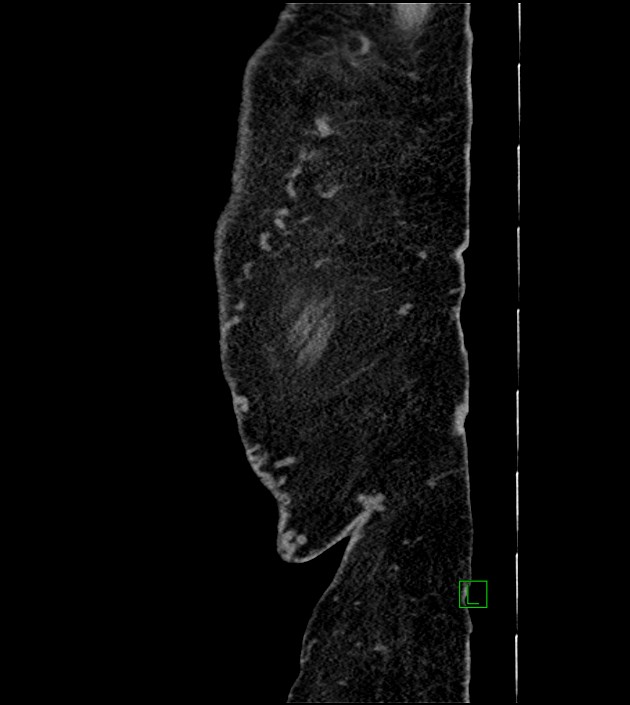 Closed-loop small bowel obstruction-internal hernia (Radiopaedia 78439-91096 C 11).jpg