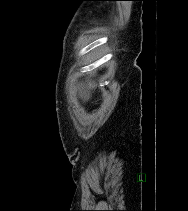 Closed-loop small bowel obstruction-internal hernia (Radiopaedia 78439-91096 C 132).jpg