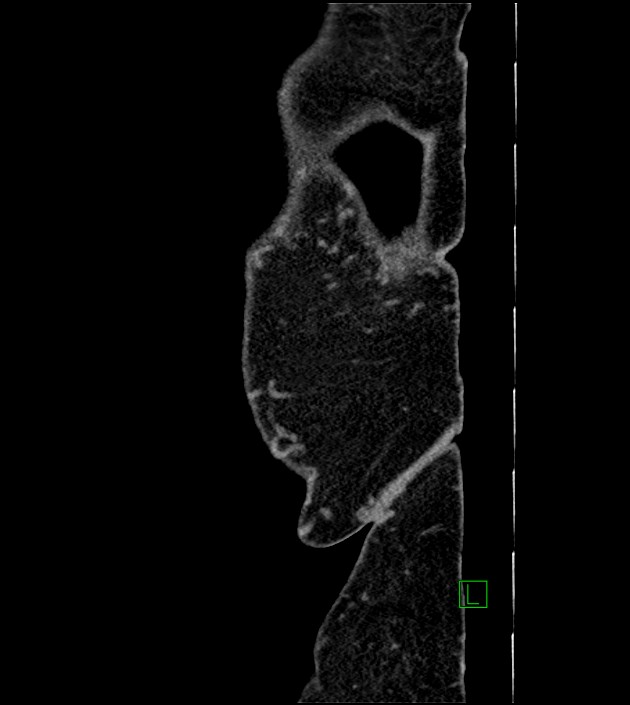Closed-loop small bowel obstruction-internal hernia (Radiopaedia 78439-91096 C 8).jpg