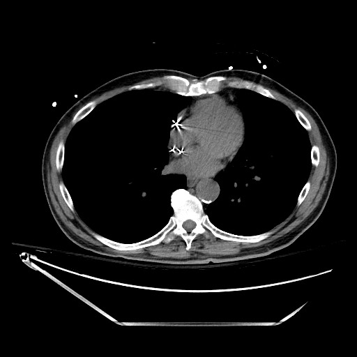 File:Closed loop obstruction due to adhesive band, resulting in small bowel ischemia and resection (Radiopaedia 83835-99023 Axial non-contrast 6).jpg