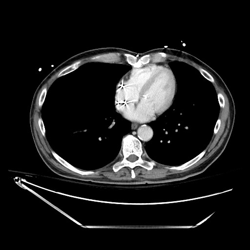 File:Closed loop obstruction due to adhesive band, resulting in small bowel ischemia and resection (Radiopaedia 83835-99023 D 10).jpg