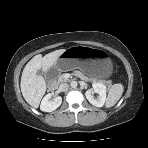 File:Closed loop small bowel obstruction (Radiopaedia 65403-74451 A 29).jpg