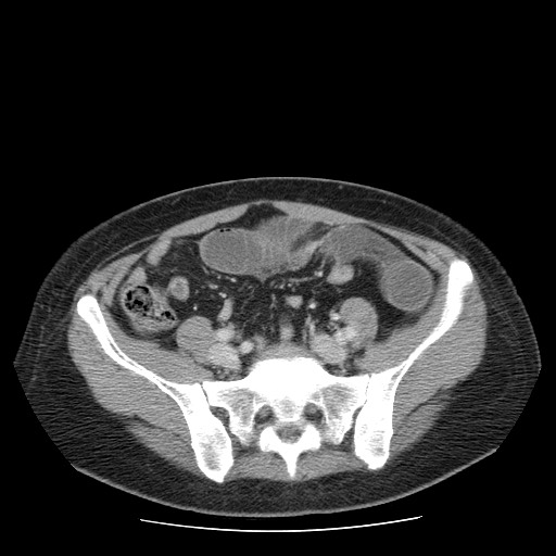 File:Closed loop small bowel obstruction (Radiopaedia 65403-74451 A 58).jpg