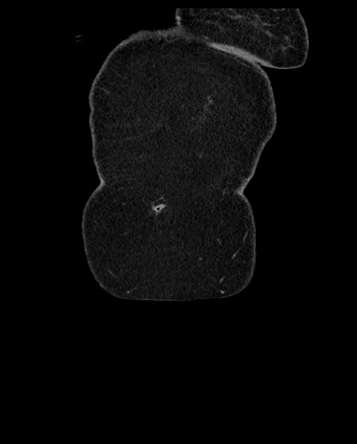 Closed loop small bowel obstruction - adhesions (Radiopaedia 59269-66611 B 9).jpg