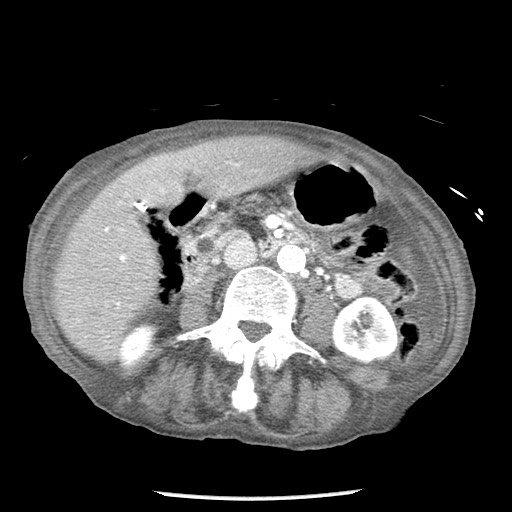Closed loop small bowel obstruction - adhesions and infarct (Radiopaedia 85125-100678 B 45).jpg