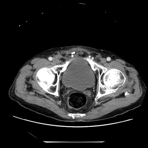 Closed loop small bowel obstruction - adhesive disease and hemorrhagic ischemia (Radiopaedia 86831-102990 A 165).jpg