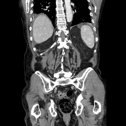 File:Closed loop small bowel obstruction - adhesive disease and hemorrhagic ischemia (Radiopaedia 86831-102990 B 98).jpg