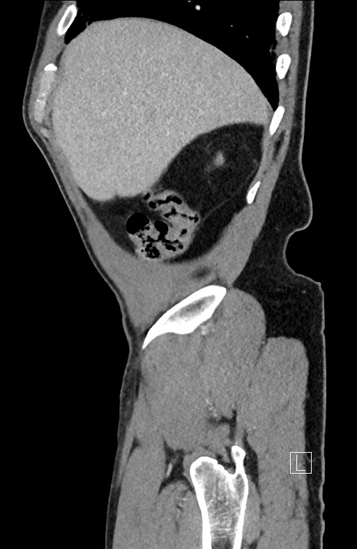 Closed loop small bowel obstruction - internal hernia (Radiopaedia 57806-64778 C 95).jpg