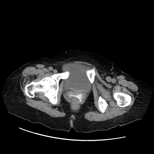 Closed loop small bowel obstruction due to adhesive band, with intramural hemorrhage and ischemia (Radiopaedia 83831-99017 Axial non-contrast 156).jpg