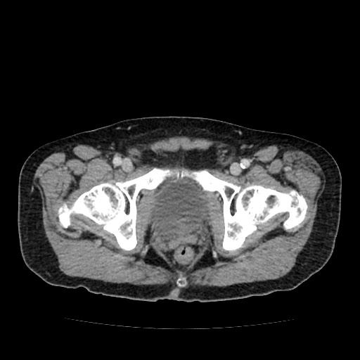 File:Closed loop small bowel obstruction due to adhesive band - U-shaped loop (Radiopaedia 83829-99012 A 69).jpg