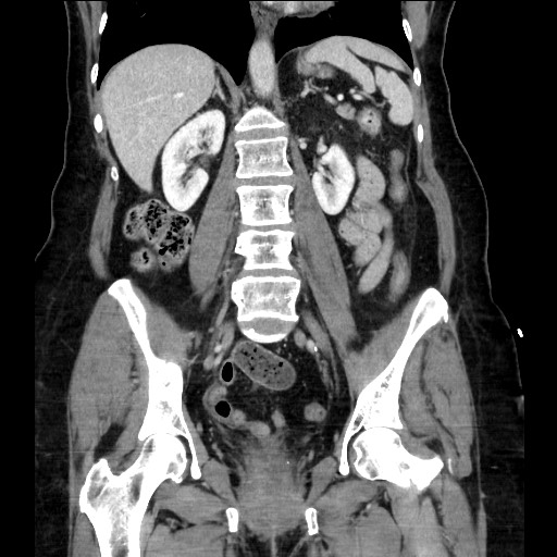 File:Closed loop small bowel obstruction due to adhesive bands - early and late images (Radiopaedia 83830-99014 B 77).jpg
