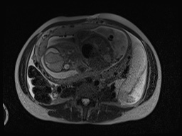 Closed loop small bowel obstruction in pregnancy (MRI) (Radiopaedia 87637-104031 D 7).jpg