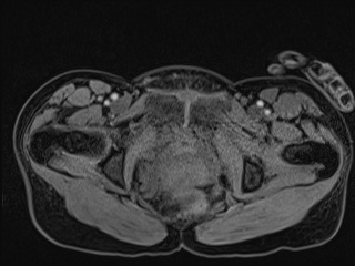 Closed loop small bowel obstruction in pregnancy (MRI) (Radiopaedia 87637-104031 G 26).jpg