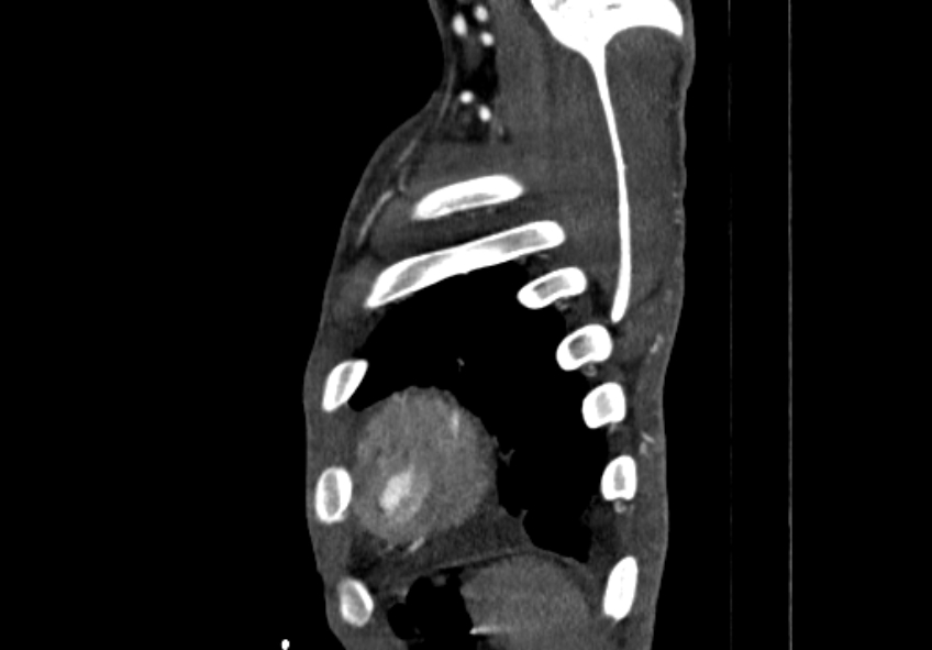Coarctation of aorta with aortic valve stenosis (Radiopaedia 70463-80574 B 227).jpg