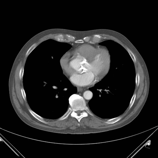 File:Coarctation of the aorta (Radiopaedia 17427-17116 B 41).jpg