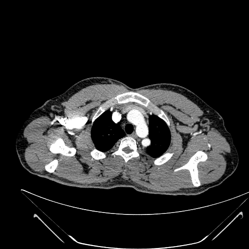 File:Coarctation of the aorta (Radiopaedia 49784-55050 B 18).jpg