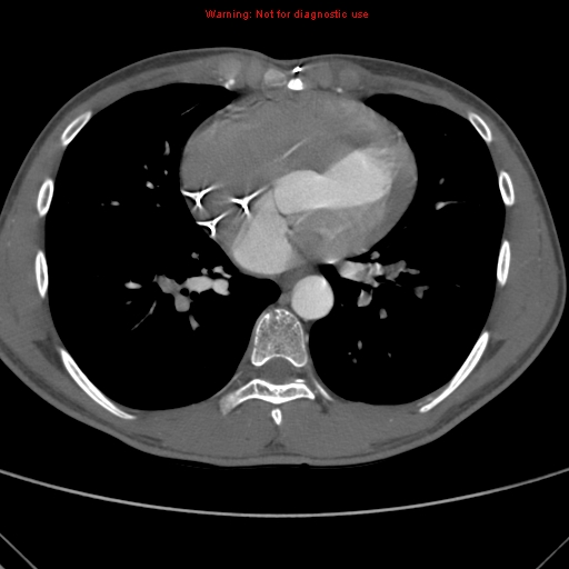File:Coarctation of the aorta (Radiopaedia 9434-10118 A 118).jpg