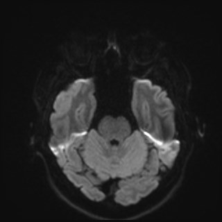 File:Cochlear incomplete partition type III associated with hypothalamic hamartoma (Radiopaedia 88756-105498 Axial DWI 53).jpg