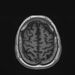 File:Cochlear incomplete partition type III associated with hypothalamic hamartoma (Radiopaedia 88756-105498 Axial T1 163).jpg