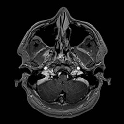 Cochlear incomplete partition type III associated with hypothalamic hamartoma (Radiopaedia 88756-105498 Axial T1 C+ 42).jpg