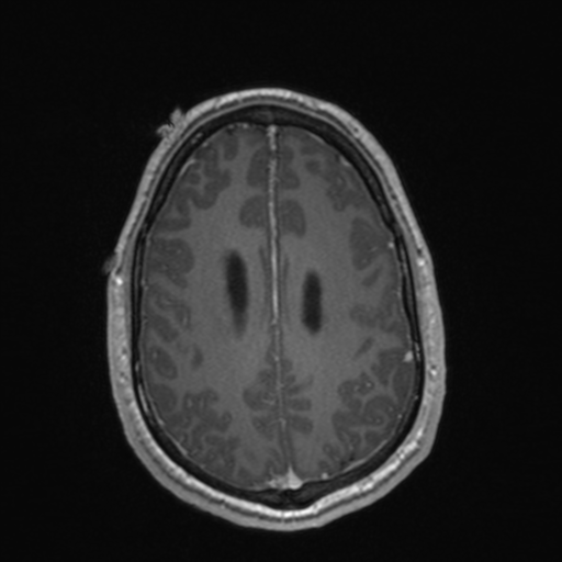 File:Colloid cyst (Radiopaedia 44510-48181 Axial T1 C+ 136).png