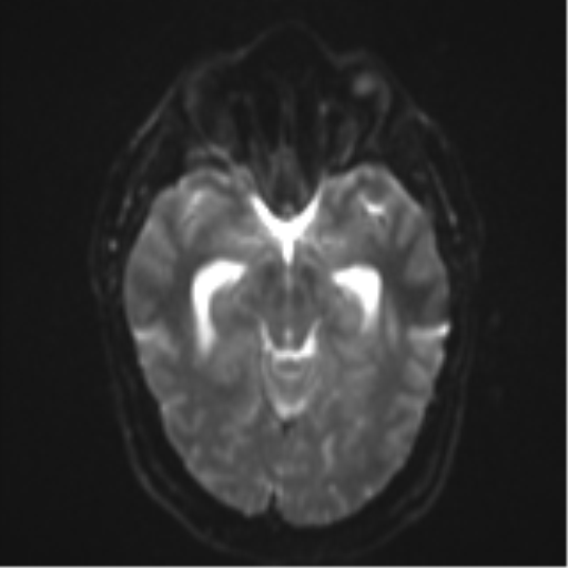 File:Colloid cyst (Radiopaedia 53164-59125 Axial DWI 11).png