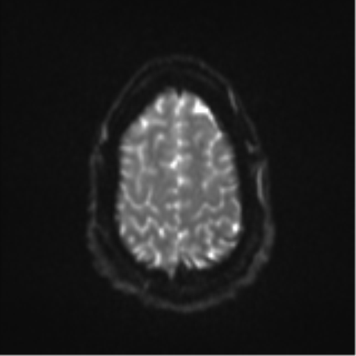 File:Colloid cyst (Radiopaedia 53164-59125 Axial DWI 25).png