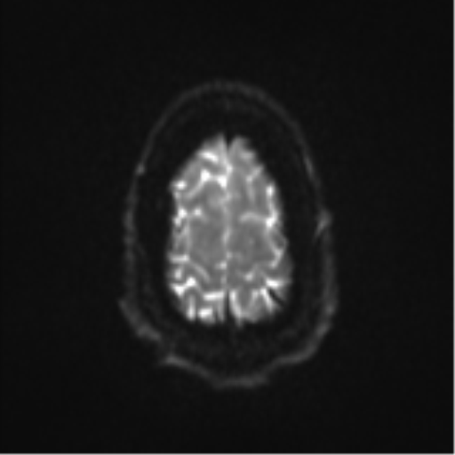 Colloid cyst (Radiopaedia 53164-59125 Axial DWI 26).png